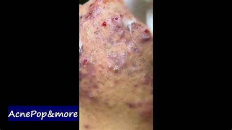 Infected cystic acne removal videos 2023 - BEST Pimple Popping // Big Cystic Acne Blackheads / Whiteheads Removal / Squeezing Pimples / Hr#110.♥ Thank you for watching!!! Support us Like Subscribe Co...